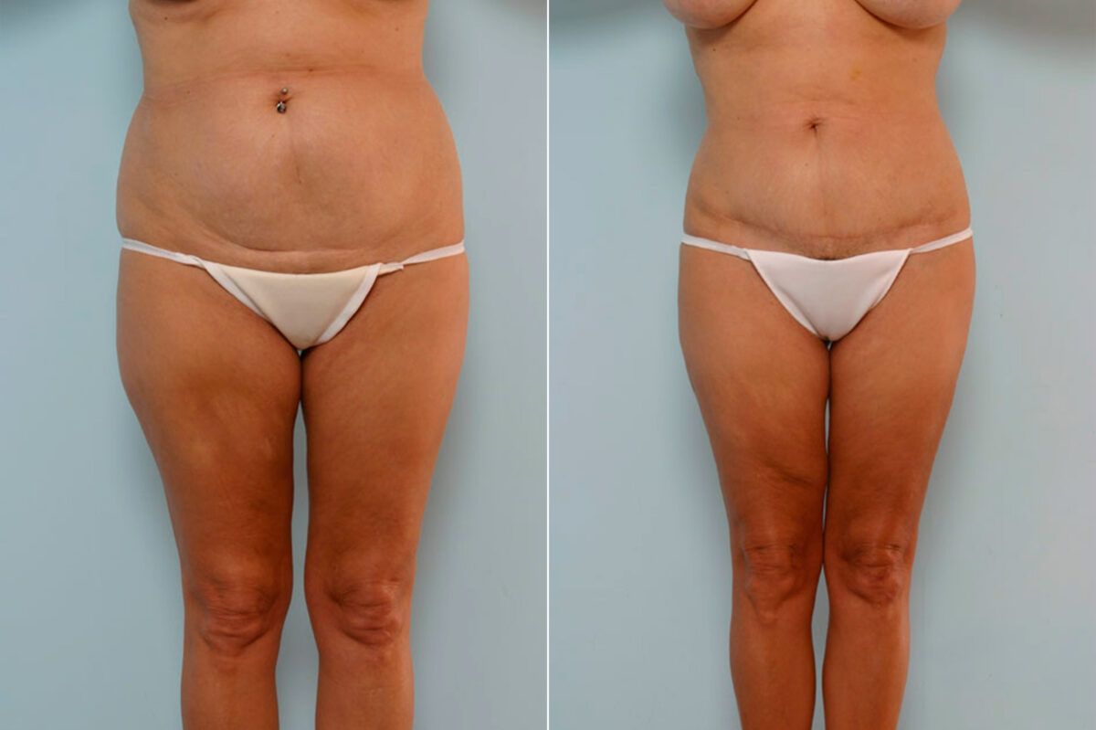 Tummy Tuck/Abdominoplasty before and after photos in Houston, TX, Patient 24588
