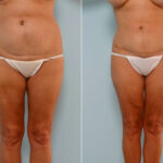 Abdominoplasty before and after photos in Houston, TX, Patient 24588