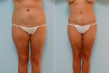 Tummy Tuck/Abdominoplasty before and after photos in Houston, TX, Patient 24588