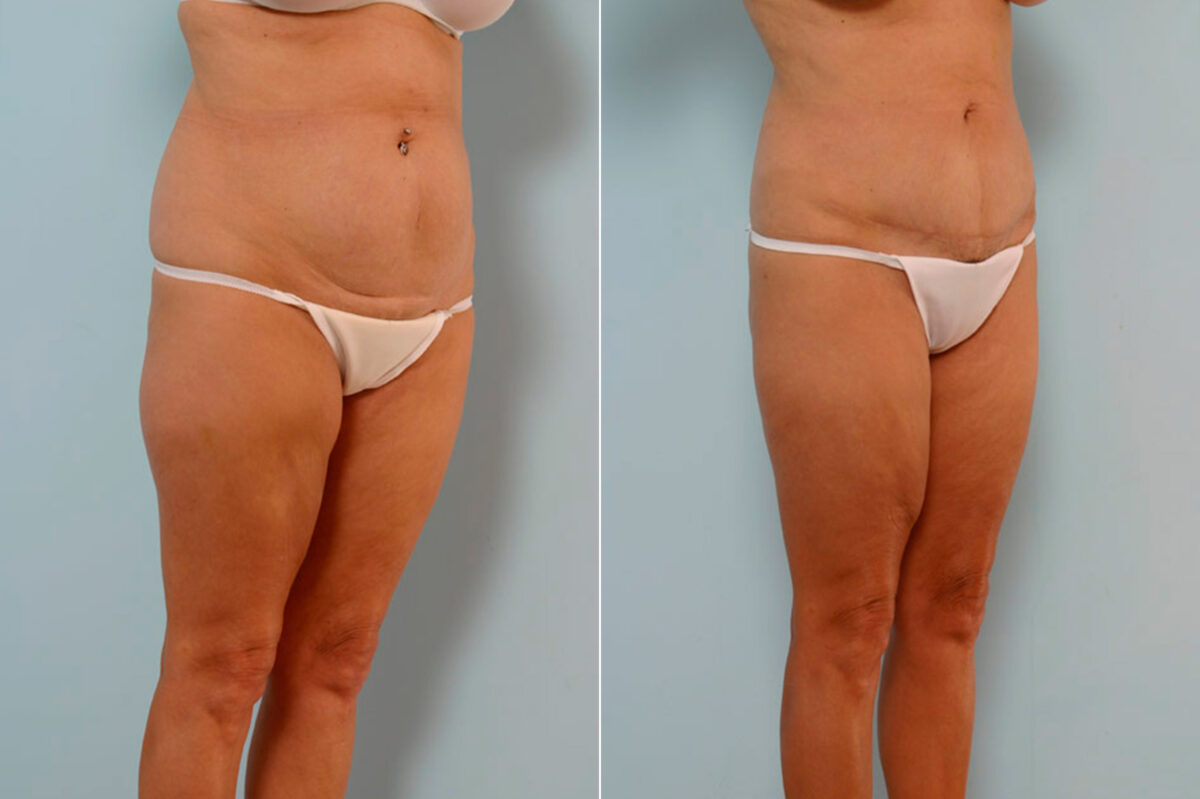Tummy Tuck/Abdominoplasty before and after photos in Houston, TX, Patient 24588