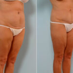 Abdominoplasty before and after photos in Houston, TX, Patient 24588