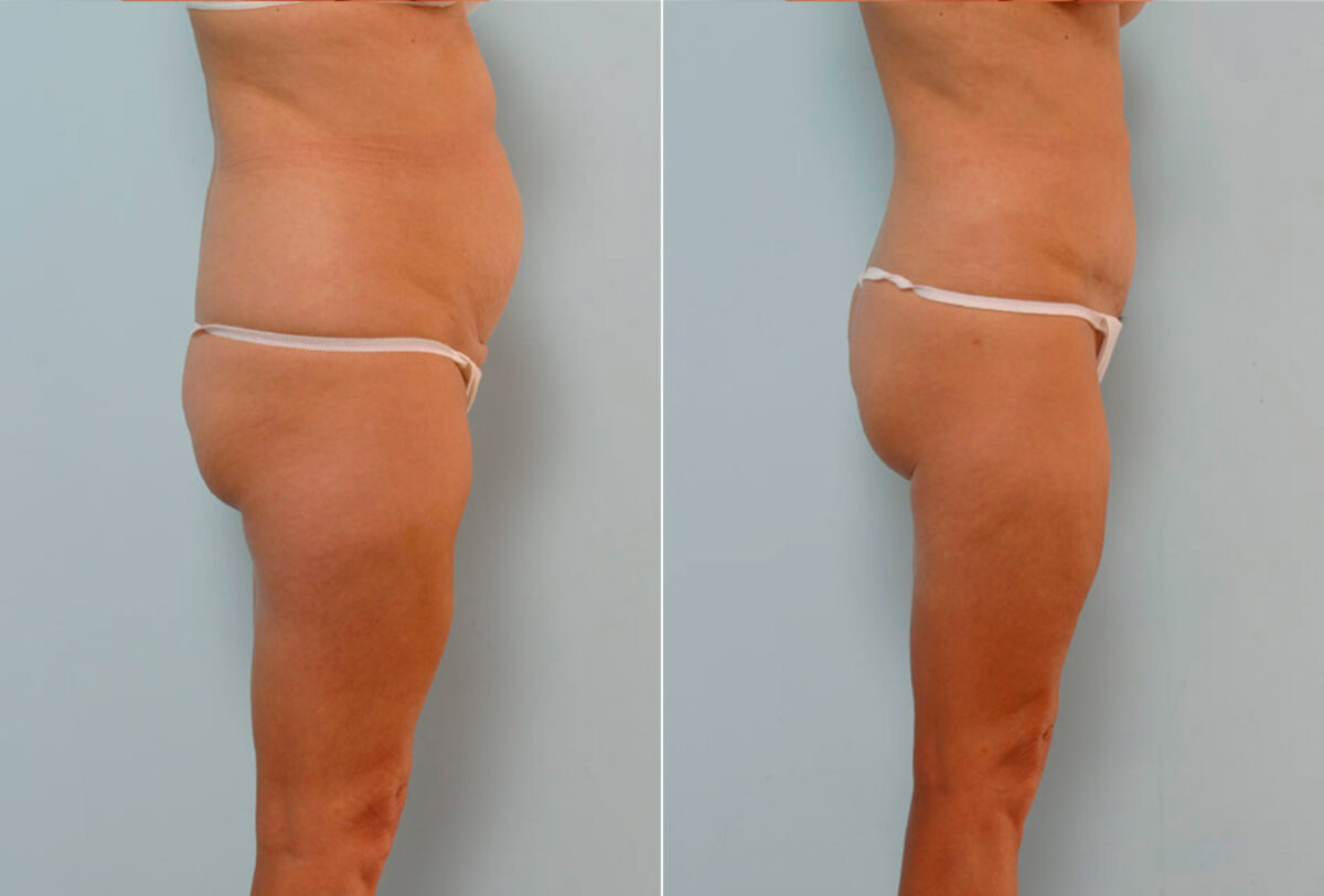 Abdominoplasty before and after photos in Houston, TX, Patient 24588