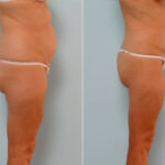 Abdominoplasty before and after photos in Houston, TX, Patient 24588