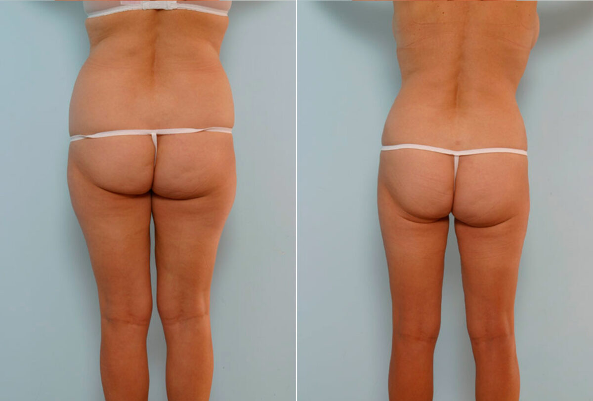 Abdominoplasty before and after photos in Houston, TX, Patient 24588