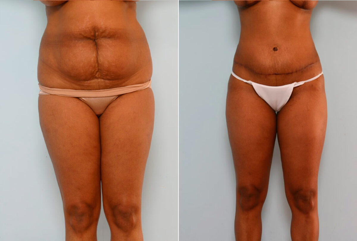 Abdominoplasty before and after photos in Houston, TX, Patient 24599