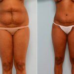 Abdominoplasty before and after photos in Houston, TX, Patient 24599