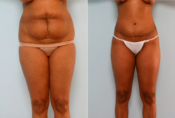 Tummy Tuck/Abdominoplasty before and after photos in Houston, TX, Patient 24599