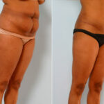 Abdominoplasty before and after photos in Houston, TX, Patient 24599