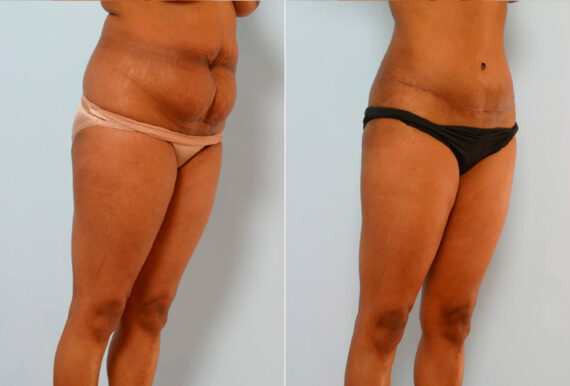 Abdominoplasty before and after photos in Houston, TX, Patient 24599