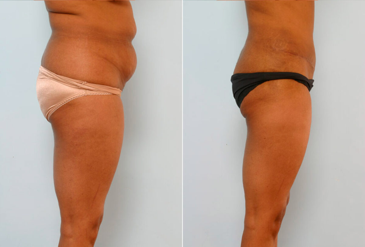 Abdominoplasty before and after photos in Houston, TX, Patient 24599