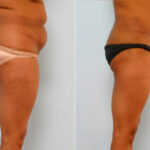 Abdominoplasty before and after photos in Houston, TX, Patient 24599