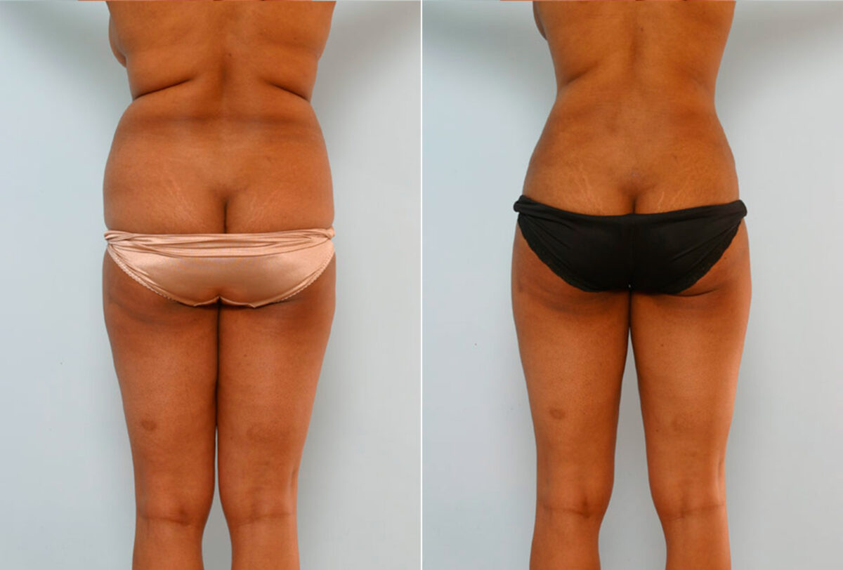 Abdominoplasty before and after photos in Houston, TX, Patient 24599