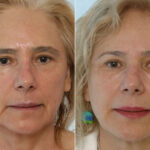 Combination Face Treatments before and after photos in Houston, TX, Patient 28248