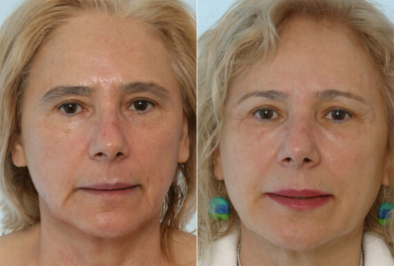 Combination Face Treatments before and after photos in Houston, TX, Patient 28248