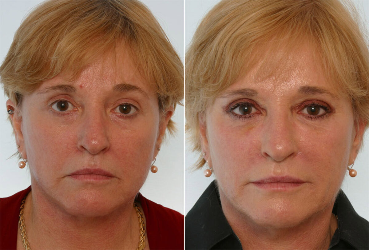 Combination Face Treatments before and after photos in Houston, TX, Patient 28256