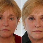 Combination Face Treatments before and after photos in Houston, TX, Patient 28256