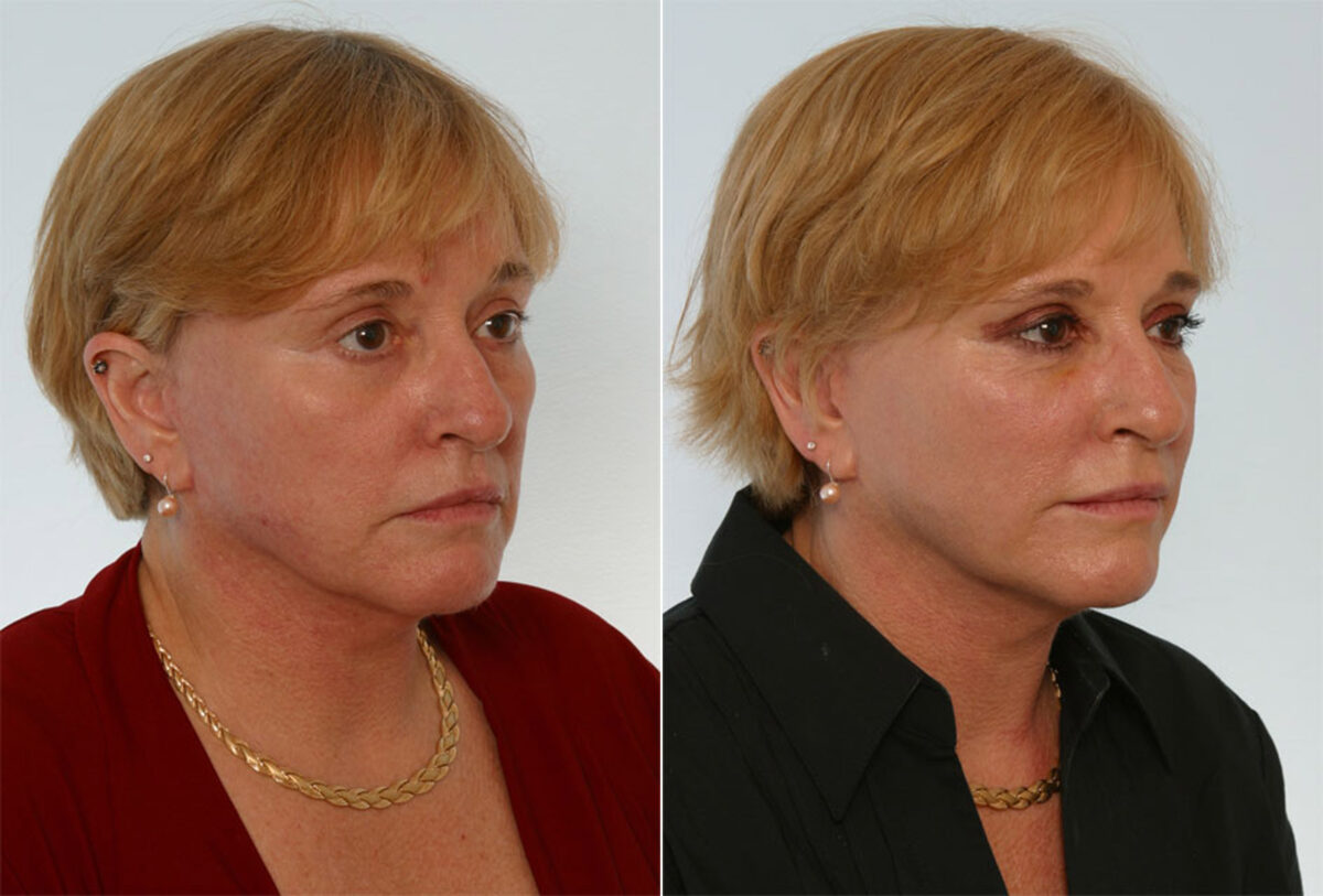 Combination Face Treatments before and after photos in Houston, TX, Patient 28256