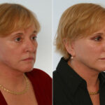 Combination Face Treatments before and after photos in Houston, TX, Patient 28256