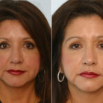 Combination Face Treatments before and after photos in Houston, TX, Patient 28261