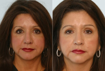 Combination Face Treatments before and after photos in Houston, TX, Patient 28261