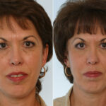 Combination Face Treatments before and after photos in Houston, TX, Patient 28264