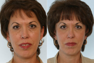 Combination Face Treatments before and after photos in Houston, TX, Patient 28264