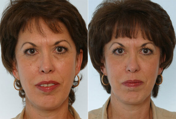 Combination Face Treatments before and after photos in Houston, TX, Patient 28264