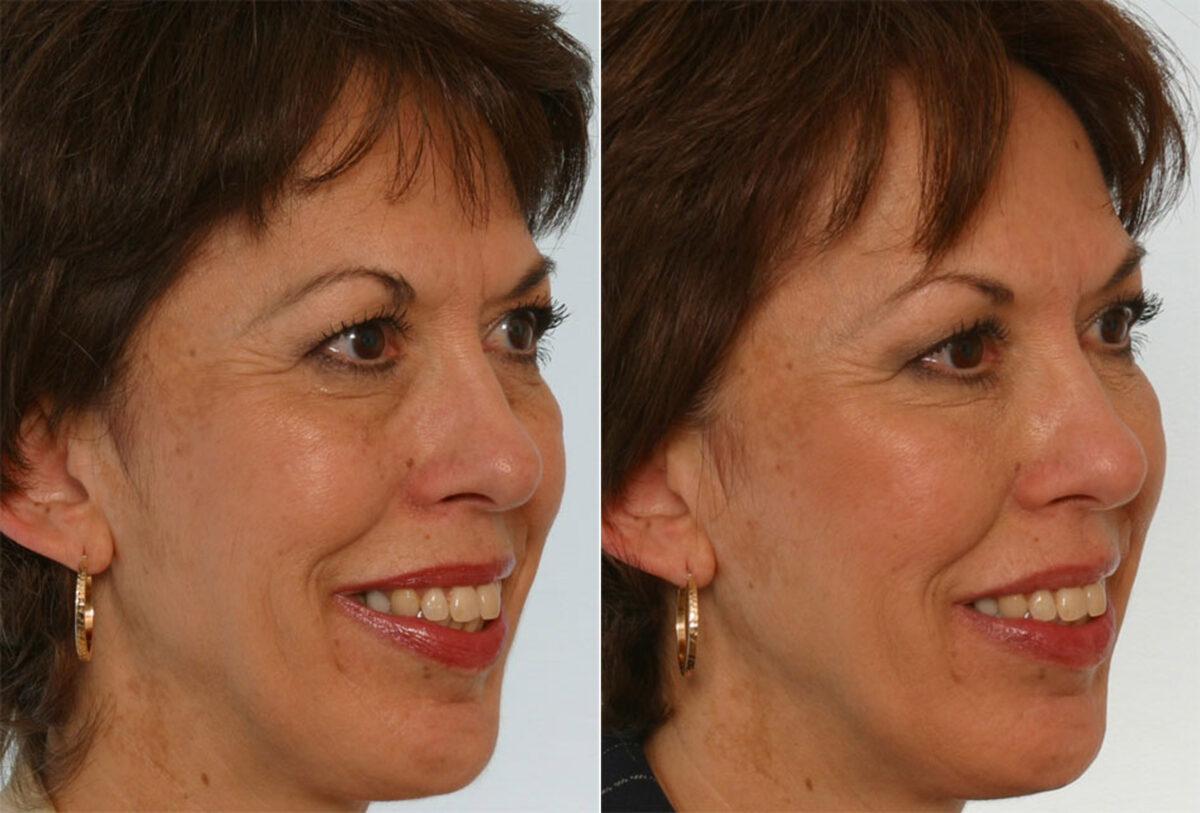 Combination Face Treatments before and after photos in Houston, TX, Patient 28264