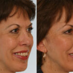 Combination Face Treatments before and after photos in Houston, TX, Patient 28264