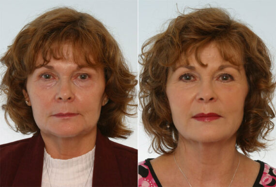 Combination Face Treatments before and after photos in Houston, TX, Patient 28269