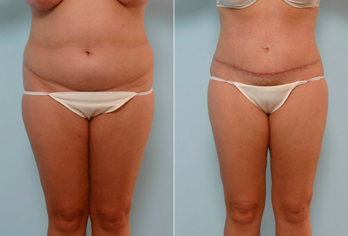 Abdominoplasty before and after photos in Houston, TX, Patient 24608