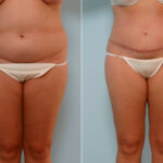 Abdominoplasty before and after photos in Houston, TX, Patient 24608