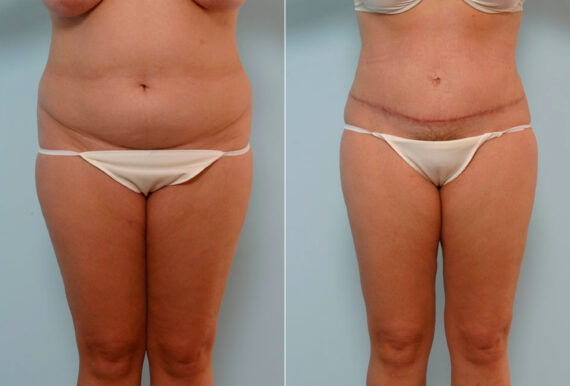 Tummy Tuck/Abdominoplasty before and after photos in Houston, TX, Patient 24608