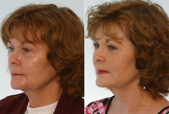 Combination Face Treatments before and after photos in Houston, TX, Patient 28269