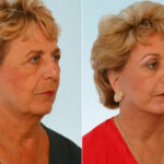 Facelift before and after photos in Houston, TX, Patient 28274