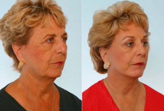 Facelift before and after photos in Houston, TX, Patient 28274