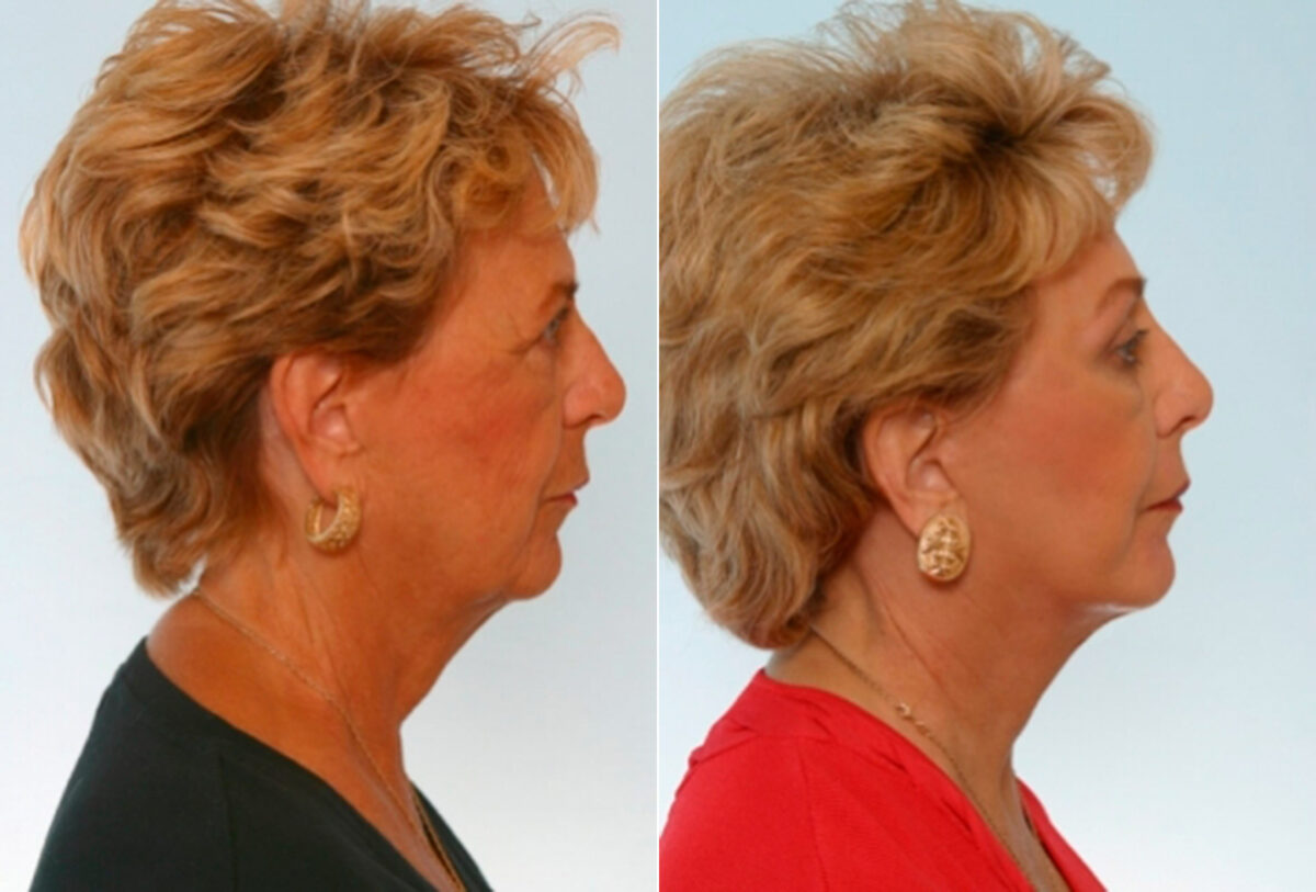 Facelift before and after photos in Houston, TX, Patient 28274