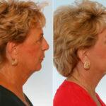 Facelift before and after photos in Houston, TX, Patient 28274