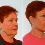 Facelift before and after photos in Houston, TX, Patient 28281