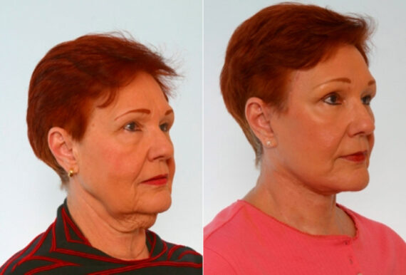 Facelift before and after photos in Houston, TX, Patient 28281