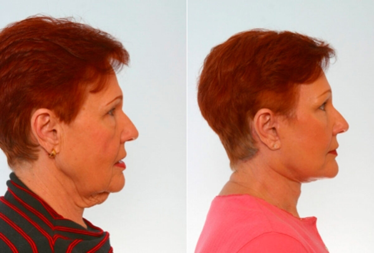 Facelift before and after photos in Houston, TX, Patient 28281