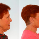 Facelift before and after photos in Houston, TX, Patient 28281