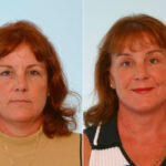 Facelift before and after photos in Houston, TX, Patient 28288