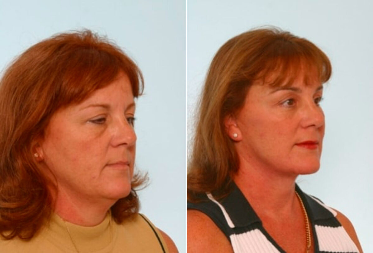 Facelift before and after photos in Houston, TX, Patient 28288