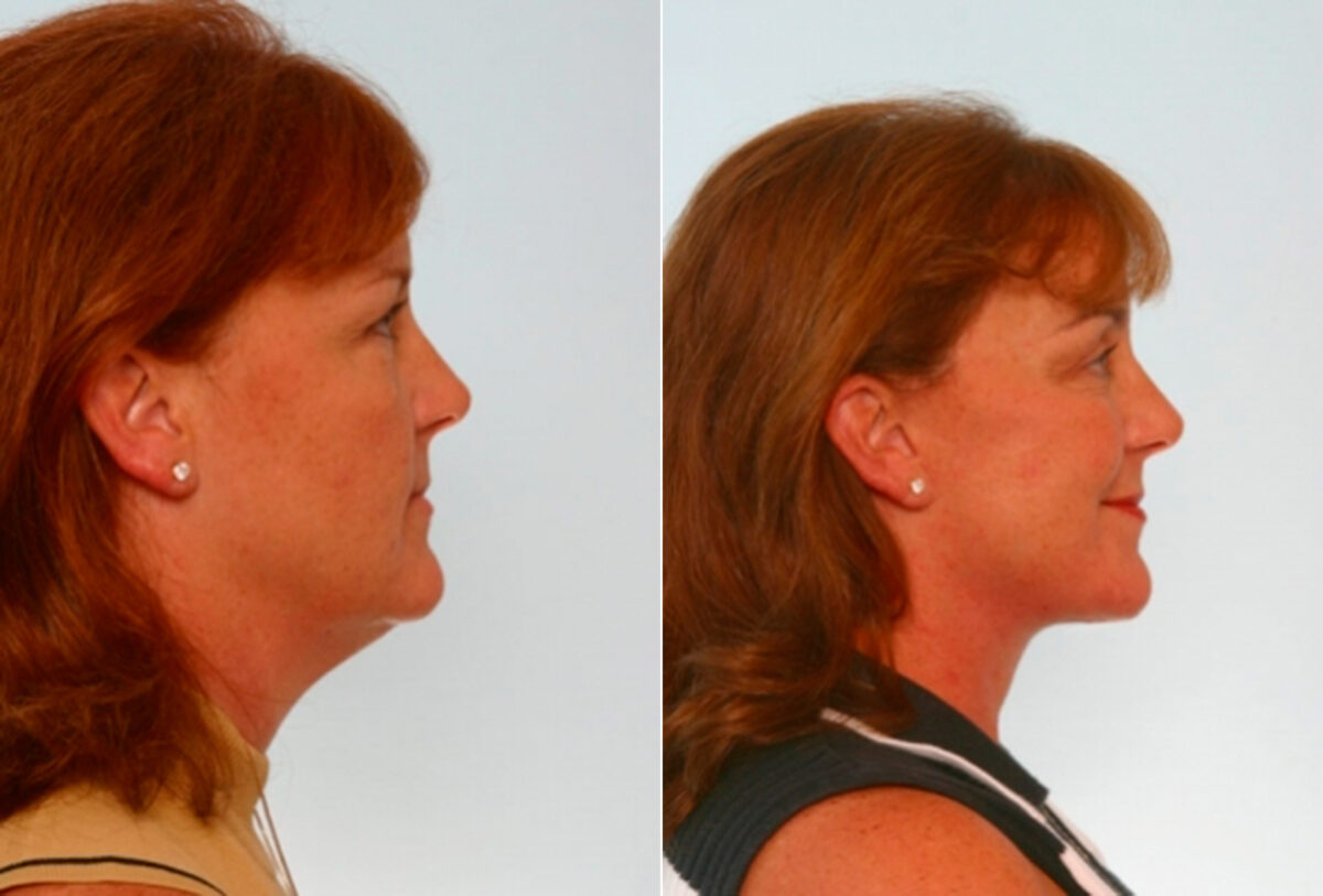 Facelift before and after photos in Houston, TX, Patient 28288