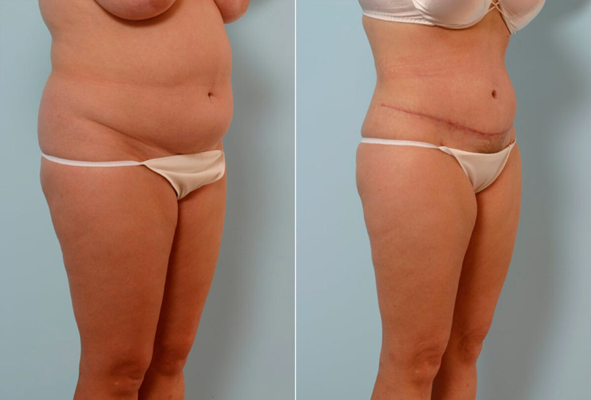 Tummy Tuck/Abdominoplasty before and after photos in Houston, TX, Patient 24608