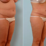 Abdominoplasty before and after photos in Houston, TX, Patient 24608