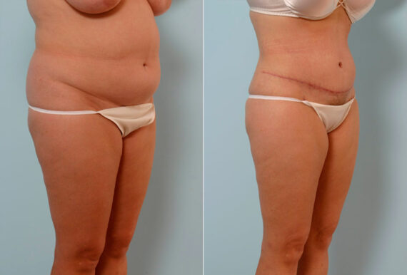 Tummy Tuck/Abdominoplasty before and after photos in Houston, TX, Patient 24608