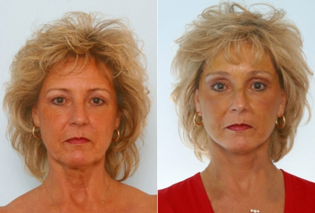 Facelift before and after photos in Houston, TX, Patient 28295