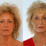 Facelift before and after photos in Houston, TX, Patient 28295